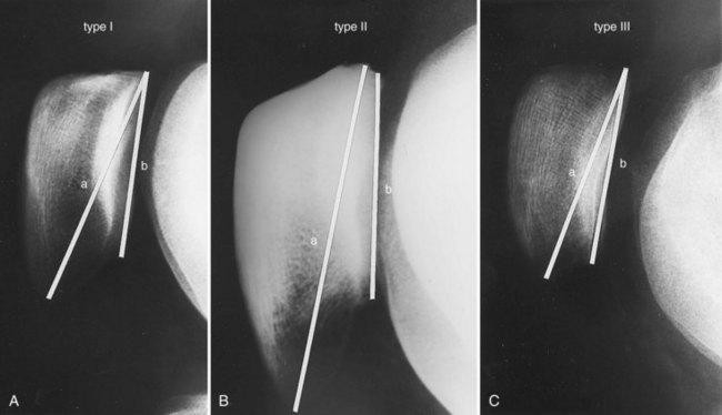 Patellar Tendinopathy