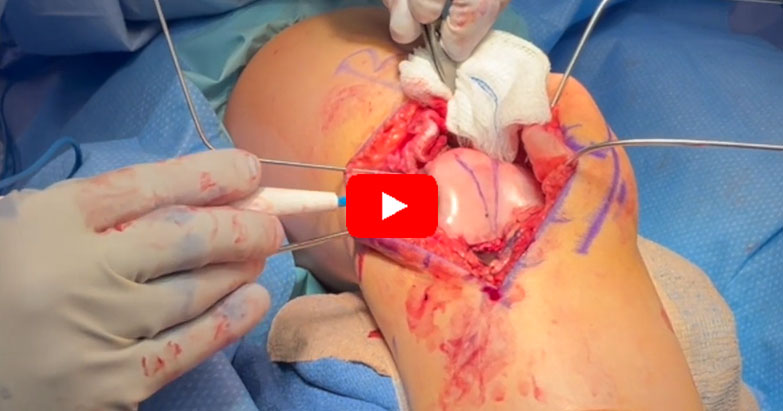 Trochleoplasty procedure for trochlear dysplasia and patellar instability