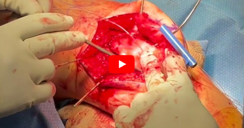 Groove Deepening Trochleoplasty for Trochlear Dysplasia