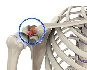 Acromioclavicular Joint Osteoarthritis