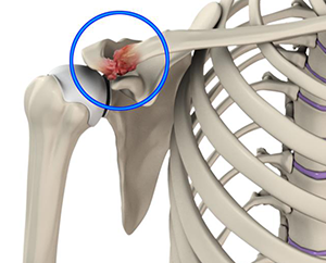 Acromioclavicular Joint Osteoarthritis