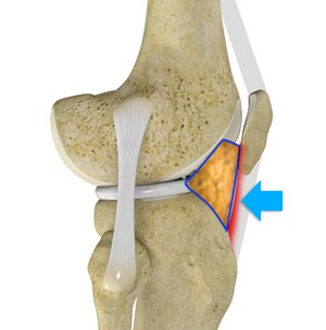 Where Is Hoffa S Fat Pad Infrapatellar Fat Pad Syndrome ASEOD