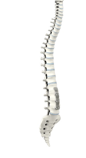 ALIF (Anterior Lumbar Interbody Fusion)