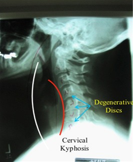 Cervical Kyphosis