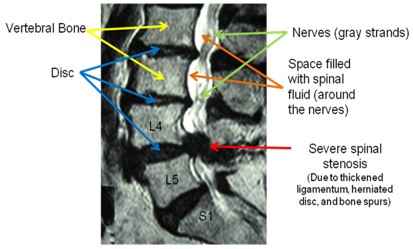 img - spinal stenosis