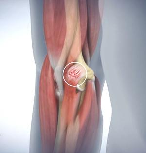 Flexor Tendon Injury