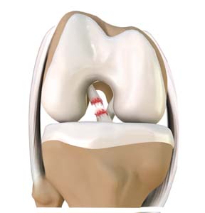 Anterior Cruciate Ligament