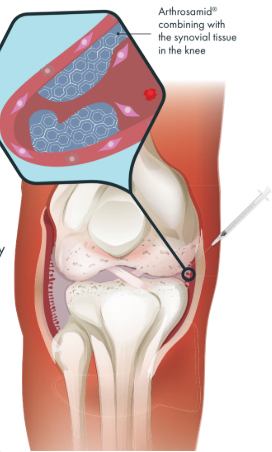 Arthrosamid® Knee Injection