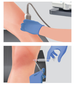Arthrosamid® Knee Injection