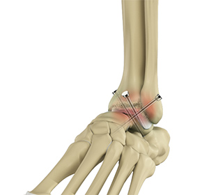 Foot & Ankle