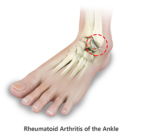 Foot & Ankle