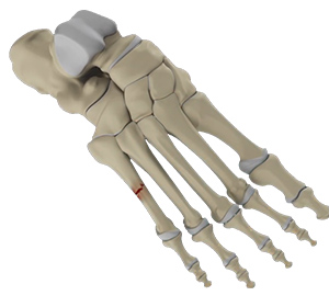 Foot & Ankle