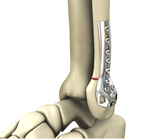 Foot & Ankle