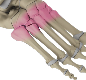 Foot & Ankle