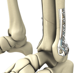 Foot & Ankle