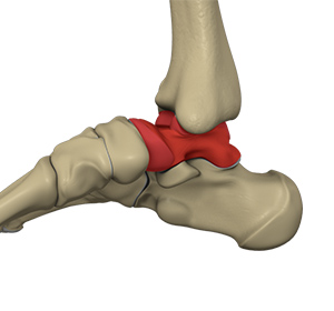 Talus Fracture