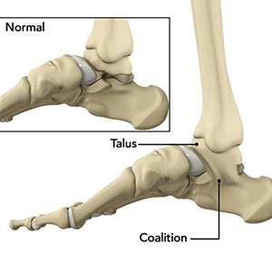Tarsal Coalition