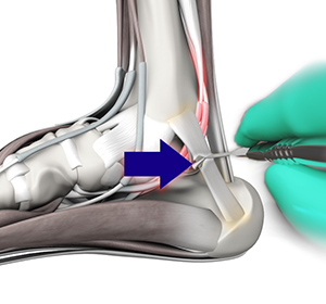 Tarsal Tunnel Syndrome