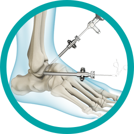 Ankle Arthroscopy