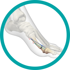 Bunion Surgery