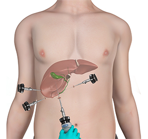 Laparoscopic Cholecystectomy