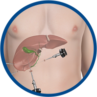 Laparoscopic Cholecystectomy