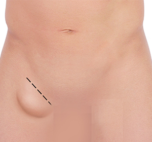 Hernia Repair