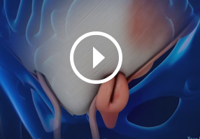 Patient Education Video