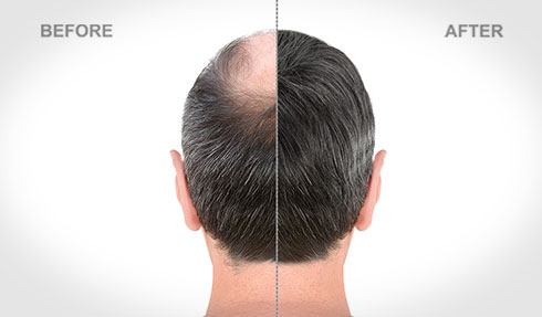 Hair Transplant (FUE)