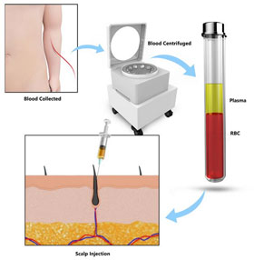 prp-hair-restoration1