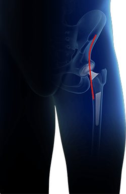 Total Knee Arthoplasty