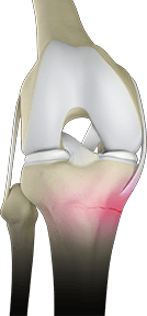 Total Knee Arthoplasty