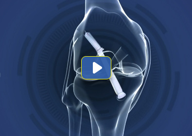 ACL Reconstruction Video