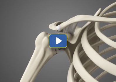 Total Shoulder Replacement Video