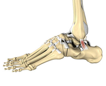 Protecting your Ankles with Keke Lyles and Betterguards Technology