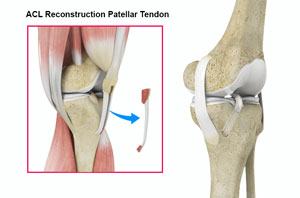 ACL Reconstruction with Patellar Tendon pic