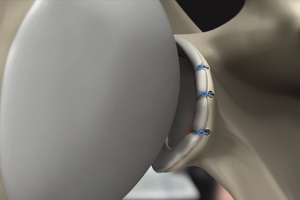 Anterior Shoulder Stabilization-topic