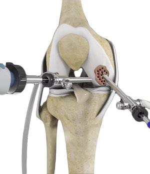 Arthroscopic Debridement of the Knee pic