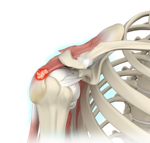 Calcific Tendinitis