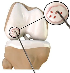 Chondroplasty pic