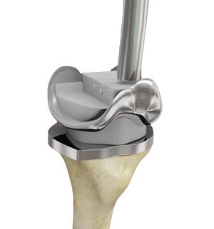 Complex Primary Knee Replacement pic
