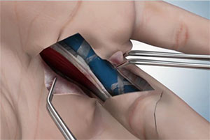 Dupuytren’s Disease Treatment in Laguna Woods, Irvine, Fountain Valley, Los Alamitos, Placentia, Yorba Linda pic