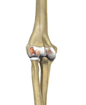Elbow Arthritis pic