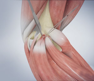 Golfer's Elbow Surgery pic