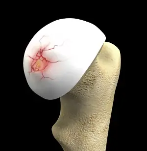 Hip Cartilage Repair pic