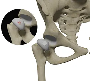 Hip Cartilage Restoration pic