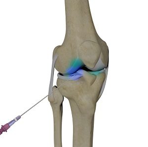 Intraarticluar Knee Injection pic