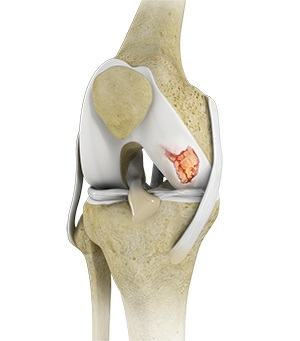 Knee Cartilage Restoration pic