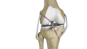 Knee Ligament Reconstruction pic