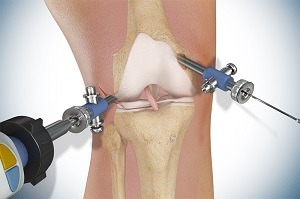 Knee Surgery pic
